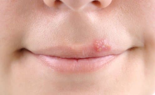 Imagem de Verão, Sol e herpes labial: existe relação?