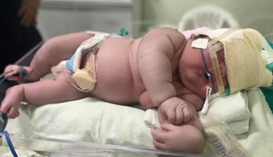 Imagem de Bebê nasce com 7 kg no Amazonas; parto foi cesárea