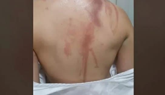 Imagem de Trote de universidade federal deixa 19 calouros com queimaduras pelo corpo no Paraná