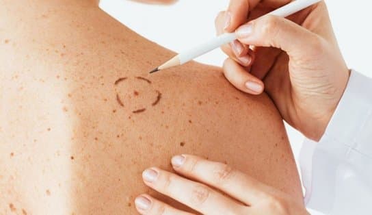 Imagem de Dermatologistas alertam sobre o melanoma, câncer de pele mais agressivo; confira cuidados e fatores de risco